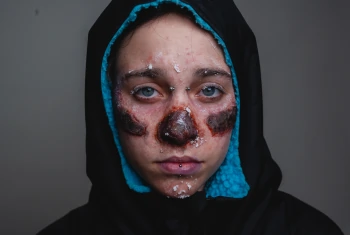 Skin Diseases Injuries
